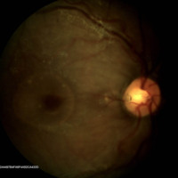 Figura 3. RG color OD. Se observa una lesión oval pequeña, grisácea, de bordes netos a nivel temporal medio de la papila que se corresponde con una foseta congénita de nervio óptico.