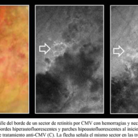 Figura 1. Detalle del borde de un sector de retinitis por CMV con hemorragias y necrosis de espesor completo (A). Bordes hiperautofluorescentes y parches hipoautofluorescentes al inicio (B) y luego de 3 semanas de tratamiento anti-CMV (C). La flecha señala el mismo sector en las tres imágenes.