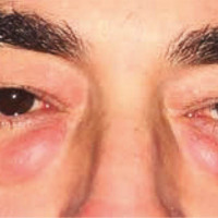 Paciente varón de 47 años con surco lacrimonasal acentuado y herniación de paquetes grasos inferiores.