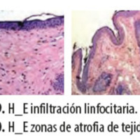 Figura 19. H_E infiltración linfocitaria.<br />
Figura 20. H_E zonas de atrofia de tejido muscular.