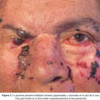 Figura 3. La paciente presenta múltiples lesiones pigmentadas y ulceradas en la piel de la cara. Una gran lesión en el área malar izquierda próxima al área periocular. 