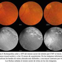 Figura 3. Retinografías color y AFF del mismo sector de retinitis por CMV al inicio, a los 4 meses (reactivación) y a los 18 meses de seguimiento. En las imágenes inferiores se visualizan los bordes de retina afectada más definidos y con mayor contraste por AFF. Las flechas señalan el mismo sector de retina en las tres imágenes.