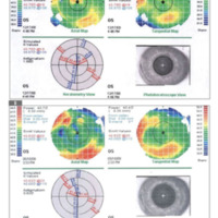 Figure 3. Corneal topography at presentation (a) and at 2 months after 3rd session of Nd:YAG laser treatment (b).