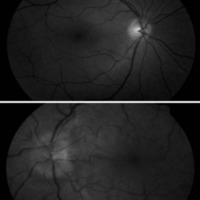 Figura 2. Funduscopía normal en OD (a la izquierda), pliegues retinales y edema de papila OI (a la derecha).