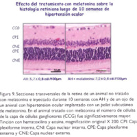 Figura 9. Secciones transversales de la retina de un animal no tratado con melatonina e inyectado durante 10 semanas con AH y de un ojo de un animal con hipertensión ocular implantado con un pellet subcutáneo<br />
de melatonina. En el animal tratado con melatonina el número de células de la capa de células ganglionares (CCG) fue significativamente mayor. Tinción con hematoxilina y eosina, magnificación original X 200. CPI: Capa plexiforme interna, CNI: Capa nuclear interna, CPE: Capa plexiforme externa y CNE: Capa nuclear externa.