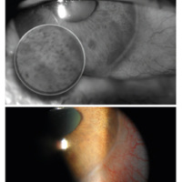 Síndrome iridocórneo endotelial: esquema diagnóstico ante una hipertensión ocular unilateral