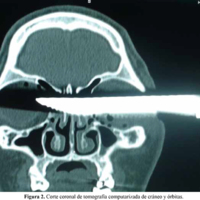 Figura 2. Corte coronal de tomografía computarizada de cráneo y órbitas.