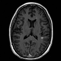 Figure 2. Axial T1-weighted MRI showing contrast enhancement of a characteristic white matter lesion in a patient with multiple sclerosis.