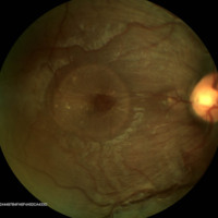 Figura 2. RG color OD. Se observa una sobreelevación redondeada circunscripta a nivel macular que se corresponde con un edema macular.