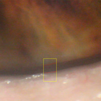 Figura 4. Fotograma real tomado durante el estudio: en rojo se ve la demarcación automática del menisco lagrimal.