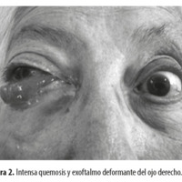 Figura 2. Intensa quemosis y exoftalmo deformante del ojo derecho.