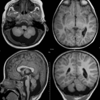 Figura 1. Resonancia magnética de malformación de Dandy-Walker, hipoplasia del vermis y hemisferio cerebeloso, displasia de corteza cerebelosa y heterotopía en banda periventricular.
