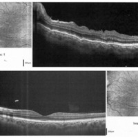 Figura 4. OCT macular que objetiva y cuantifica edema retinal con pliegues maculares y edema de papila (arriba). Resolución del edema retinal (abajo).