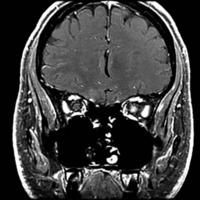 Figure 1. Coronal T1-weighted MRI of the orbits with fat suppression shows enhancement of the left intraorbital optic nerve in a patient with optic neuritis. 