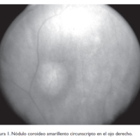 Metástasis Coroidea Bilateral como Presentación de un Adenocarcinoma Esofágico