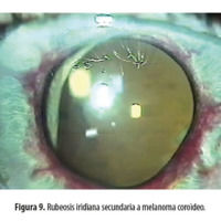 Figura 9. Rubeosis iridiana secundaria a melanoma coroideo.