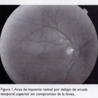 Oclusión de rama arterial retinal: a propósito de un caso