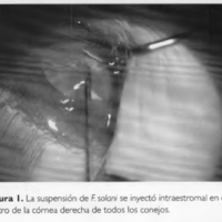 Tratamiento de queratitis micótica por Fusarium con crosslinking corneal
