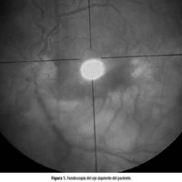 Obstrucción de rama arterial en la retina en paciente joven asociada a un asa vascular prepapilar