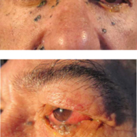Figuras 1 y 2. Múltiples lesiones pigmentadas en piel de la cara. Algunas afectan el párpado inferior con alteración de su anatomía, como se ve en el ojo izquierdo. 