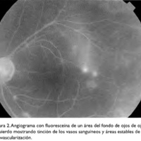 Figura 2. Angiograma con fluoresceína de un área del fondo de ojos de ojo izquierdo mostrando tinción de los vasos sanguíneos y áreas estables de neovascularización.