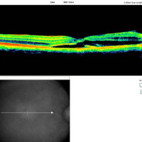 Figura 13. OCT macular OD. Corte transversal. Se observa la franca disminución del edema macular. Persiste una pequeña cantidad a nivel del haz papilomacular.