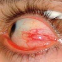 Respuesta Paradojal durante el Tratamiento de Tuberculosis Ocular en un Paciente Inmunocompetente VIH Negativo