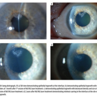 Nd:YAG laser in the treatment of recurrent interface epithelial ingrowth after laser in situ keratomileusis