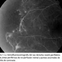 Figura 1. La retinofluoresceinografía del ojo derecho reveló periflebitis activa, áreas periféricas de no-perfusión retinal y puntos anormales de pérdida de contraste.