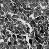 Figura 6. Células neoplásicas pigmentadas y no<br />
pigmentadas del melanoma epiteloide.