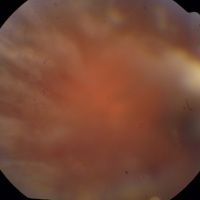 Figura 1. Varón de 42 años con compromiso bilateral por linfoma vitreorretinal primario. Se observa la disposición típica “en lámina” de la vitreítis.
