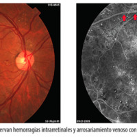 Figura 3. Retinopatía no proliferativa: se observan hemorragias intrarretinales y arrosariamiento venoso con edema macular focal.