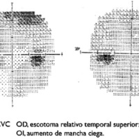 Fig. 5. Caso 2. CVC OD, escotoma relativo temporal superior;<br />
0I, aumento de mancha ciega.