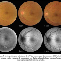 Figura 5. Retinografías color e imágenes de AFF del mismo sector de retinitis por CMV al inicio, a las 4 semanas y a las 6 semanas de seguimiento. Las flechas señalan las líneas hiperautofluorescentes paravasculares en las tres tomas seriadas.