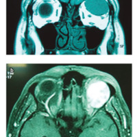 Figura 11. RMN corte coronal en T1: masa delimitada isointensa con el parénquima cerebral; corte axial en T1 con gadolineo: masa con realce homogéneo característico.