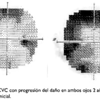 Fig. 6. Caso 2. CVC con progresión del daño en ambos ojos 2 años después de la consulta inicial.