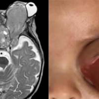 Figura 3. A) RMN en T2 de paciente de 7 meses de edad con tumor de saco vitelino. B) Imagen externa del paciente.
