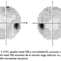 Fig. 1O. Caso 3. CVC, escalon nasal OD, y normalidad 01. aumento mancha ciega y escalon nasal OD, aumento de la mancha ciega, defector en periferia nasal y pequeño escotomas temporal.