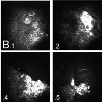 Diagnóstico In vivo de Cambios Neoplásicos Epiteliales Corneo-Conjuntivales utilizando Microscopía Confocal