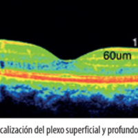 Angiografía de retina por tomografía de coherencia óptica (OCT-A)