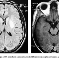Figuras 2 y 3: RMN con contraste: necrosis laminar cortical difusa en corteza occipital que realza con gadolinio.