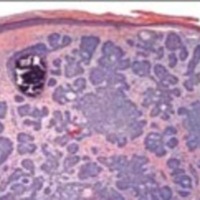 Figura 3. B) Melanocitos entre las células basales y las células neoplásicas que contienen cantidades variables de melanina (carcinoma basocelular pigmentado).