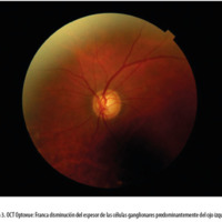 Figura 3. OCT Optovue: Franca disminución del espesor de las células ganglionares predominantemente del ojo izquierdo.<br />
