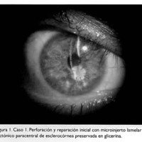 Microinjertos tectónicos excéntricos en infecciones corneales activas, perforaciones y descemetoceles secundarios a queratitis infecciosas