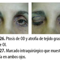 Figura 26. Ptosis de OD y atrofia de tejido graso en órbita de OI.<br />
Figura 27. Marcado intraquirúrgico que muestra la asimetría en ambos ojos.