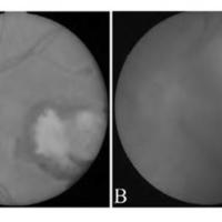 Figura 1. A. Lesión macular característica de toxoplasmosis congénita . B. Lesión macular por extensión de retinocoroiditis adquirida.