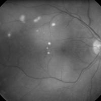 Infiltrados Retinales Puntiformes Asociados a Desprendimiento de Retina Exudativo como Primera Manifestación de Sífilis Ocular