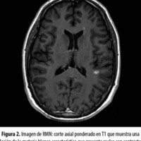 Figura 2. Imagen de RMN: corte axial ponderado en T1 que muestra una lesión de la materia blanca característica que presenta realce con contraste en un paciente con esclerosis múltiple.