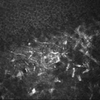 Evaluacion de la Celularidad Estromal Corneal Mediante Microscopia Confocal en Lasek con Mitomicina