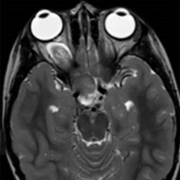Figura 6. RMN T2 de paciente de 6 años con glioma de nervio óptico derecho.